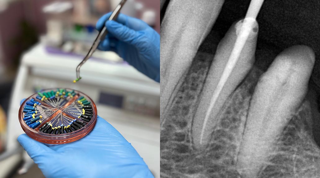 endodoncija-1